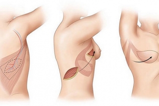 PHƯƠNG PHÁP PHẪU THUẬT BẢO TỒN VÀ PHẪU THUẬT TẠO HÌNH ĐIỀU TRỊ UNG THƯ VÚ